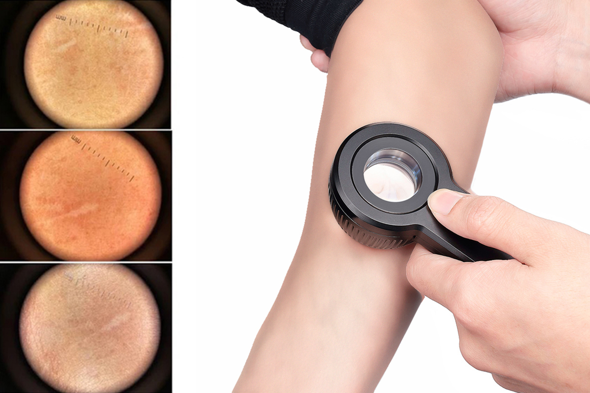 Polarized Light Dermoscopy: Clearer Skin dermatoscope Lesion