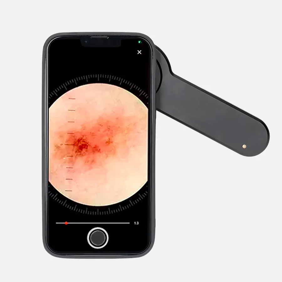 photo dermatoscope device
