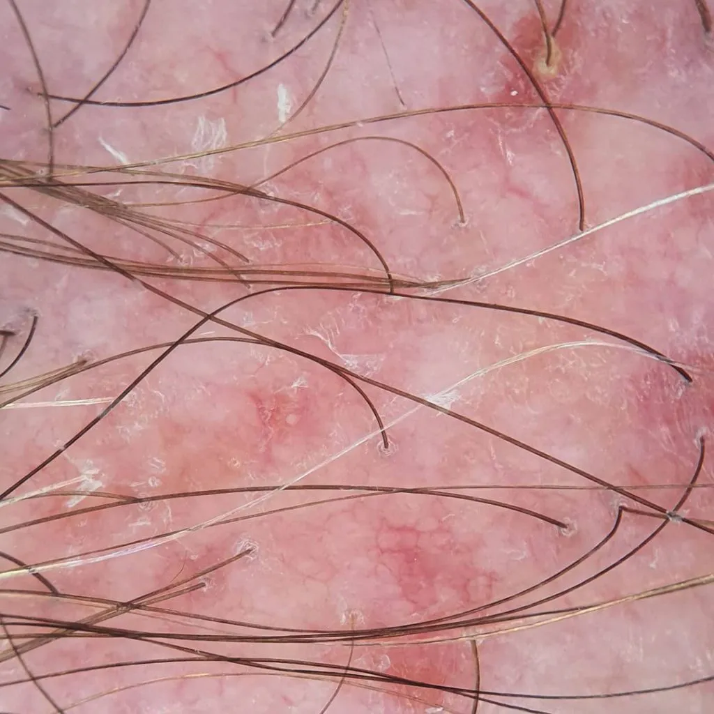 dermatoscope value
