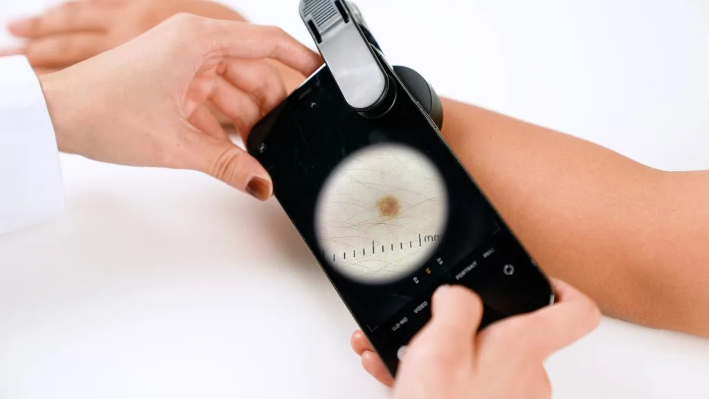 With IBOOLO DE-300 Dermatoscope