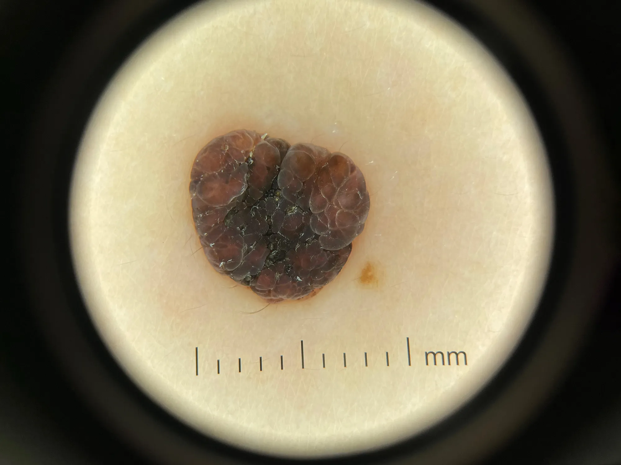 DE-3100 dermatoscope effect