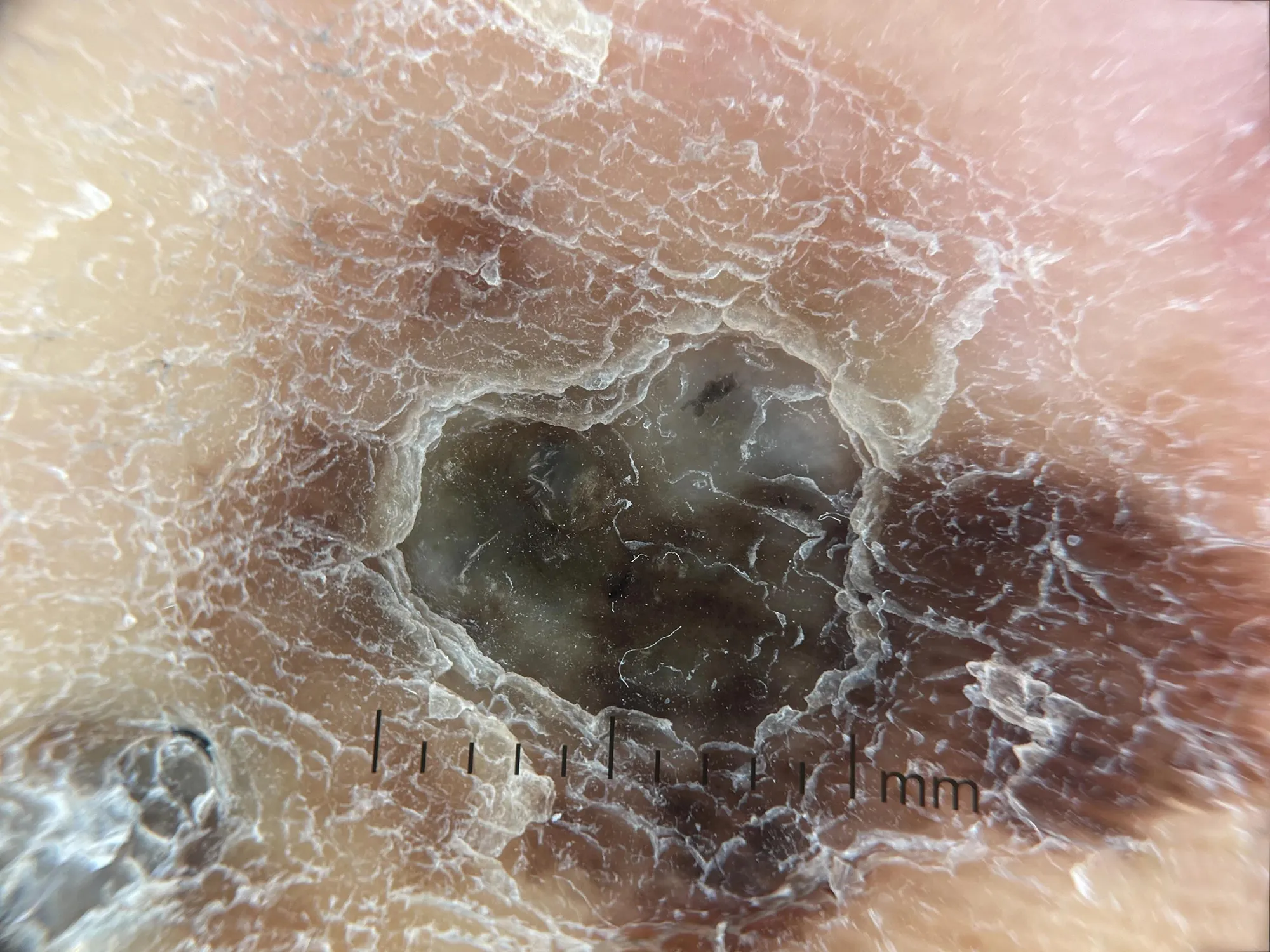 DE-4100 dermatoscope effect