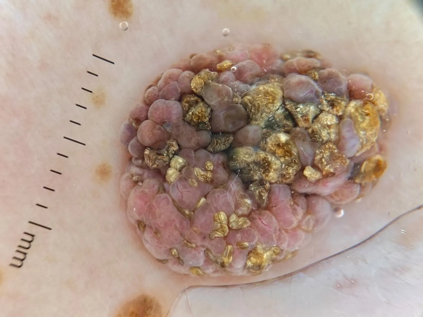 DE-4100 Dermatoscope