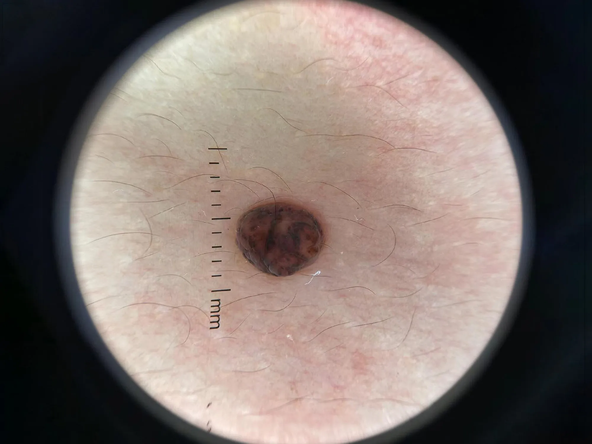 DE-4100 PRO Dermatoscope