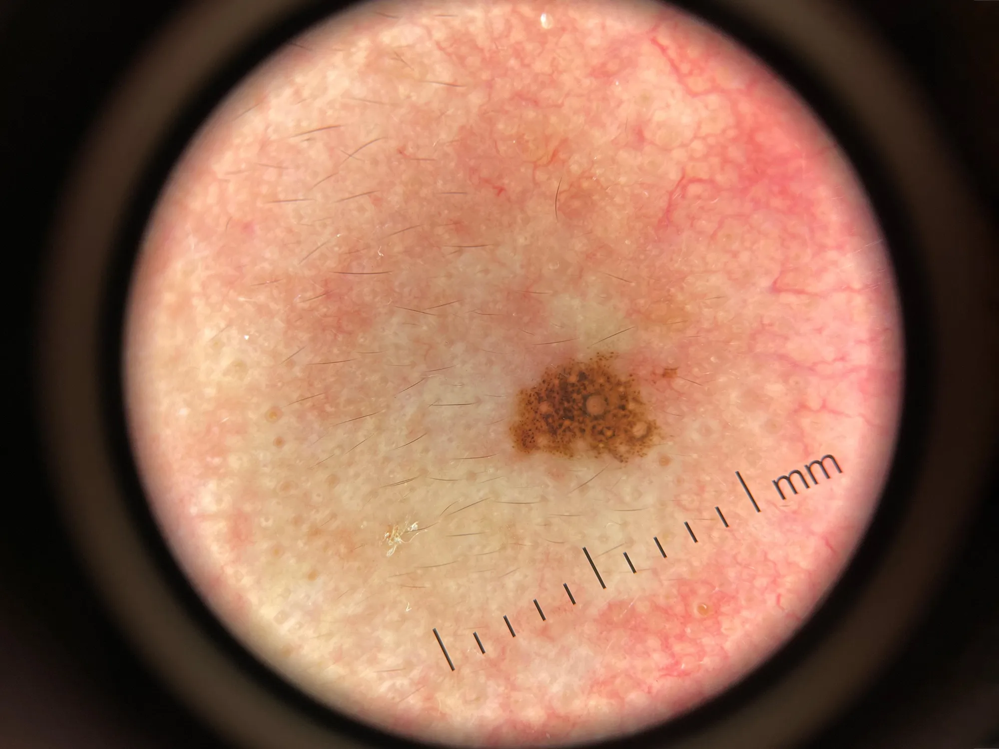 DE-3100 PRO Dermatoscope