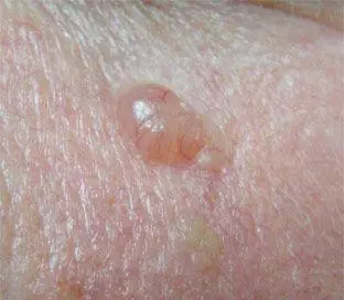 BCC symptom