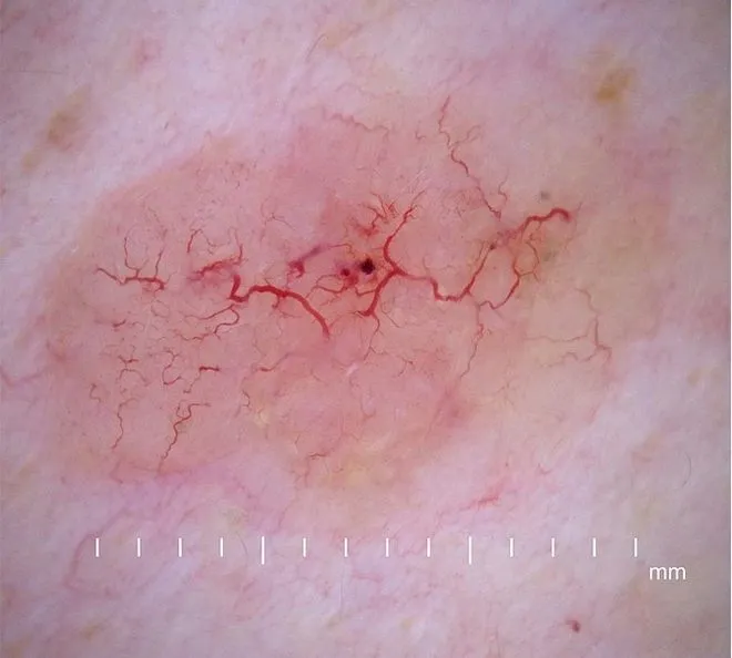 basal cell carcinoma dermoscopy