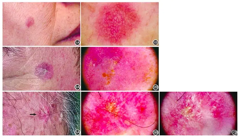 dermatoscopio view