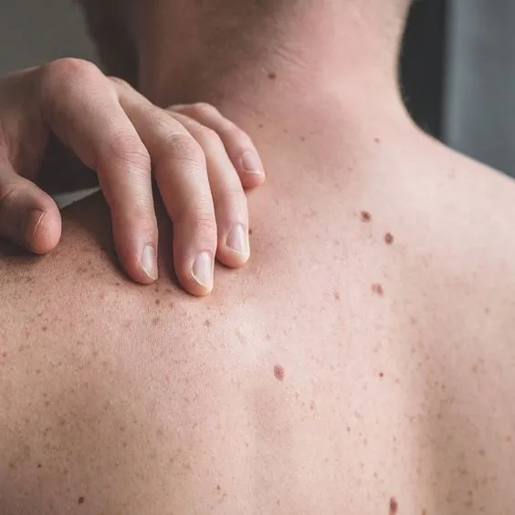 seborrheic keratosis