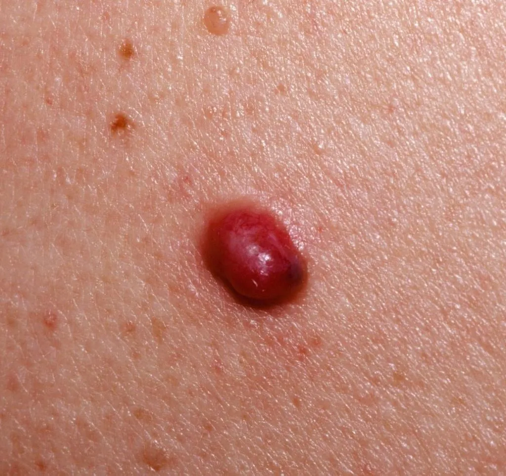 amelanotic melanoma picture