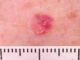 amelanotic melanoma