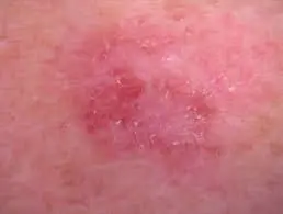 amelanotic melanoma