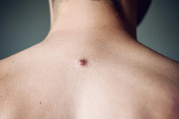 dermatofibroma picture