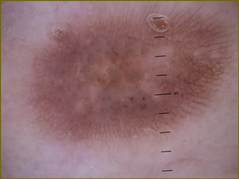dermatofibroma dermoscopy