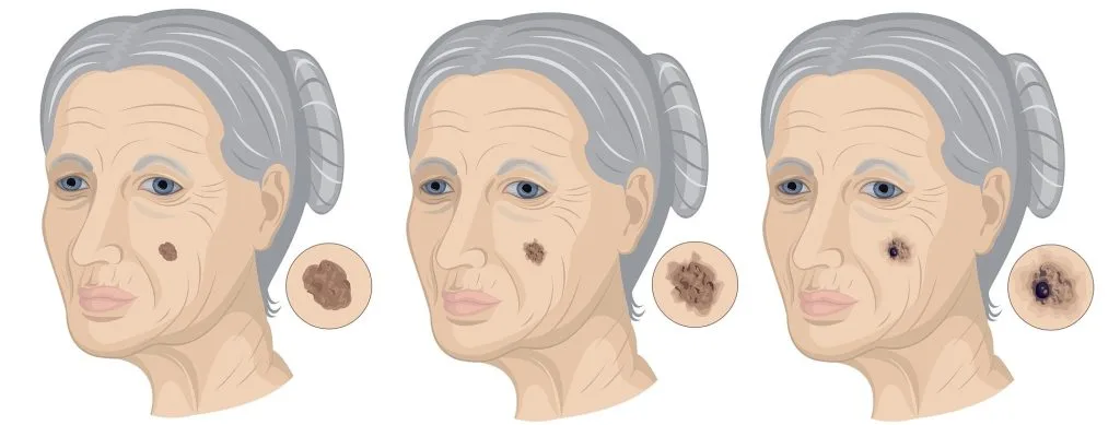 stages of lentigo maligna