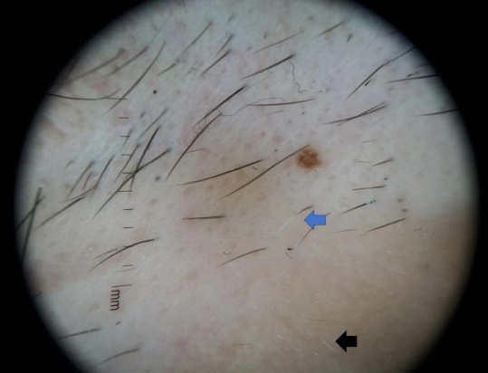 dermatoscopic features of alopecia areata