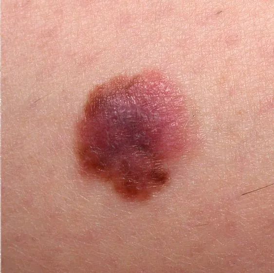 dermatoscopic features of early melanoma