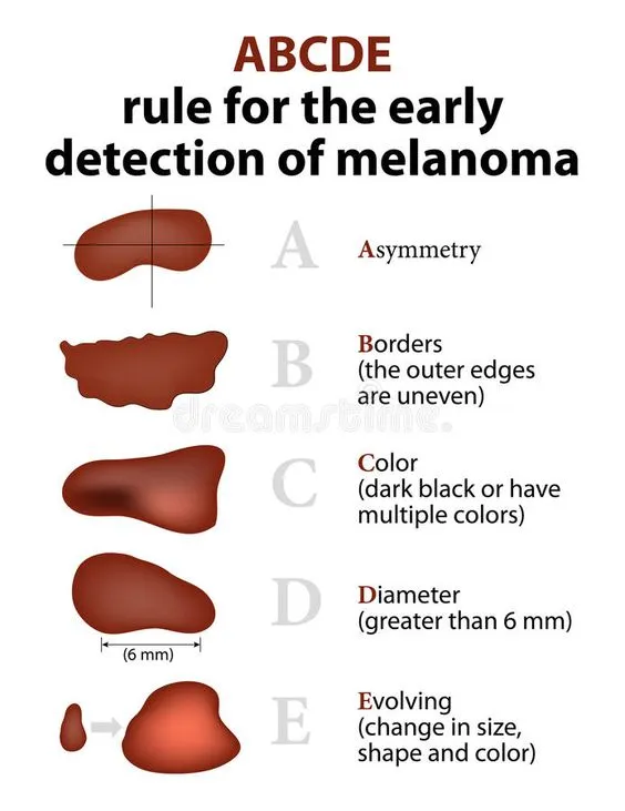 ABCDE rules for melanoma