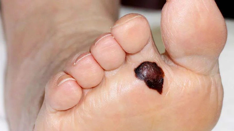 acral melanoma