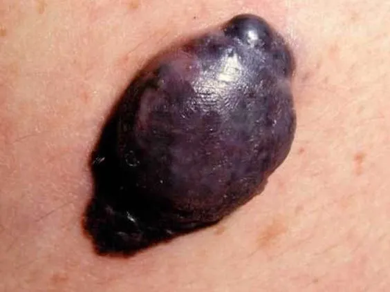 nodular melanoma