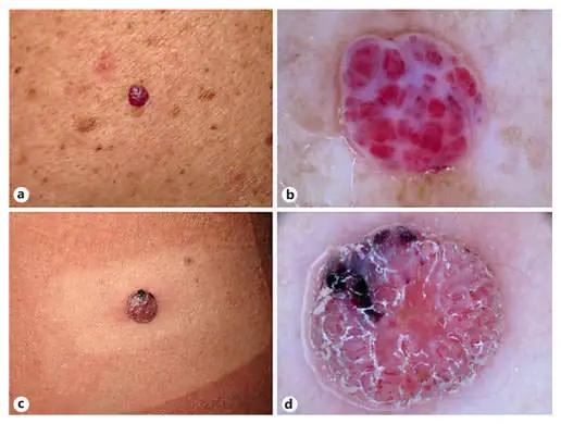 nodular melanoma dermoscopy