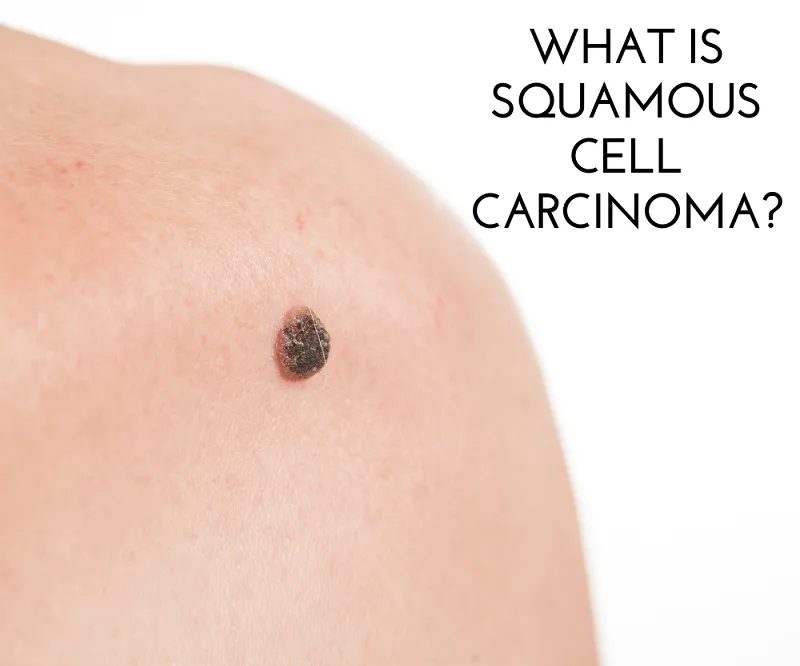 squamous cell carcinoma