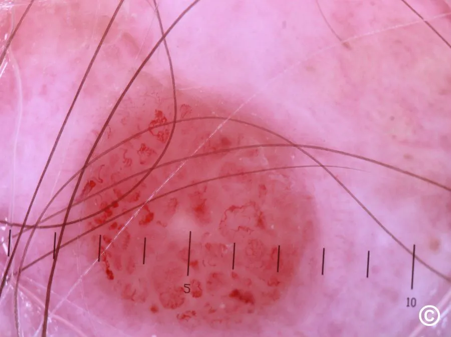 dermoscopy of squamous cell carcinoma