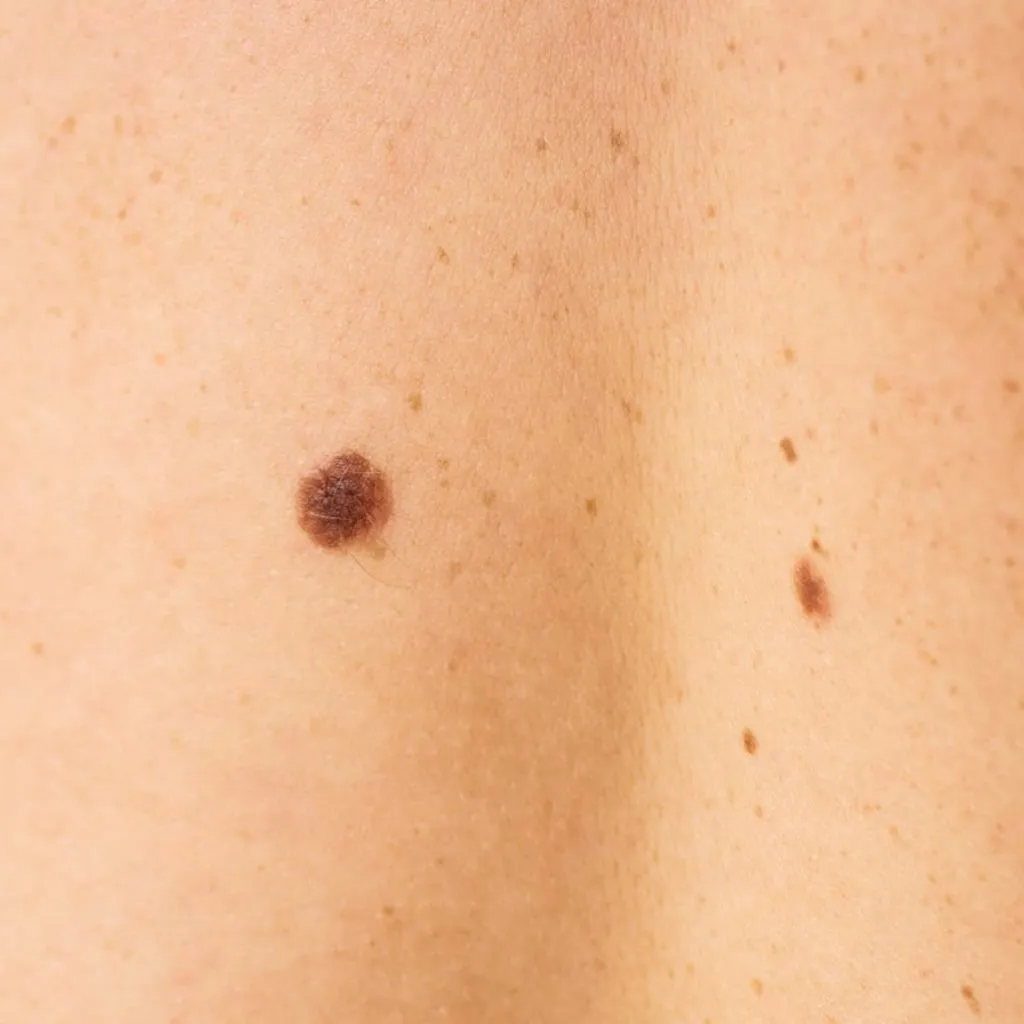 Melanocytic Nevus