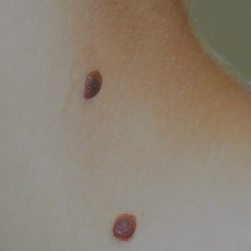 Benign Melanocytic Nevus