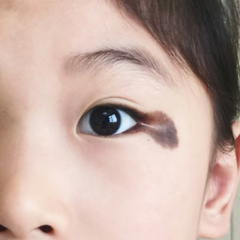 Nevi in Children