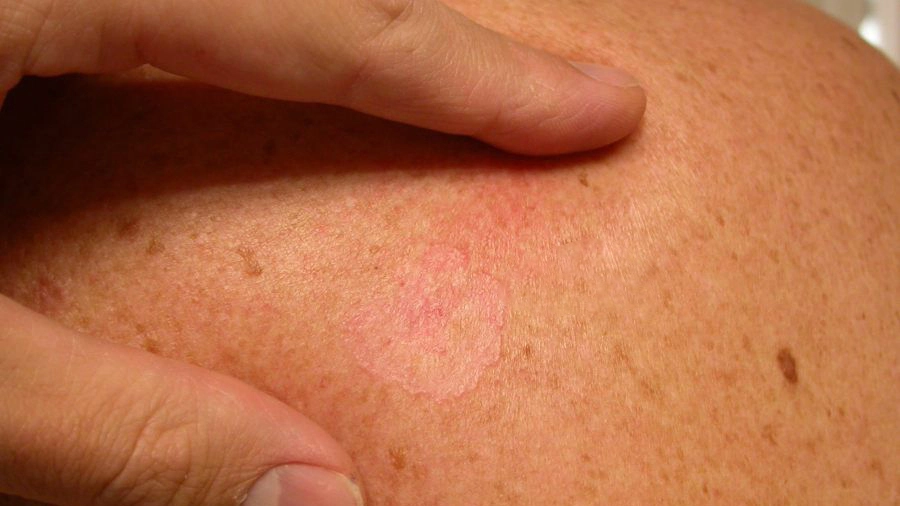 Superficial Basal Cell Carcinoma