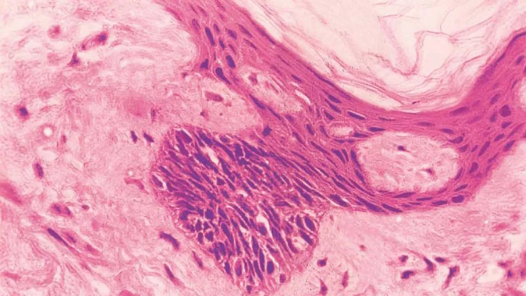 Basal Cell Carcinoma