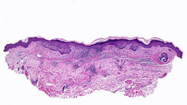 Superficial Basal Cell Carcinoma