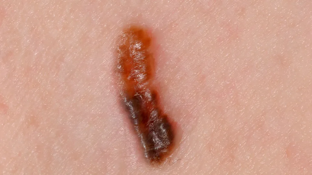 Pigmented Basal Cell Carcinoma