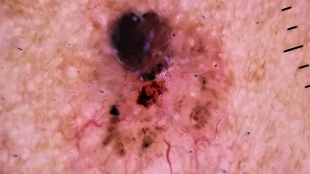 Dermoscopic Features of Pigmented Basal Cell Carcinoma