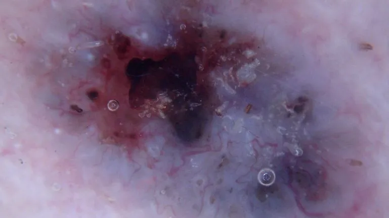 Dermoscopic Images of Pigmented Basal Cell Carcinoma