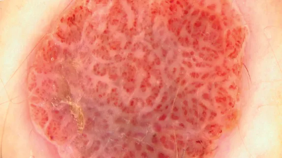 Dermoscopy of Clear Cell Acanthoma