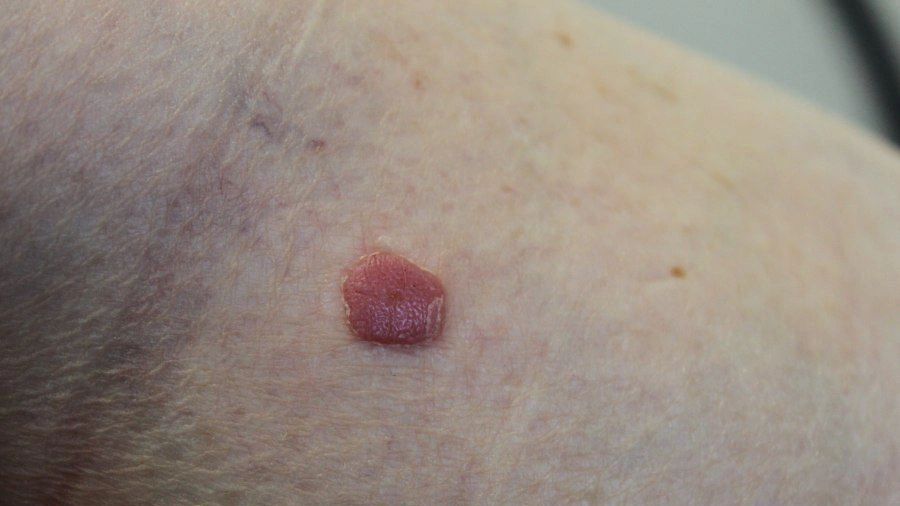 Clinical Feature of Clear Cell Acanthoma