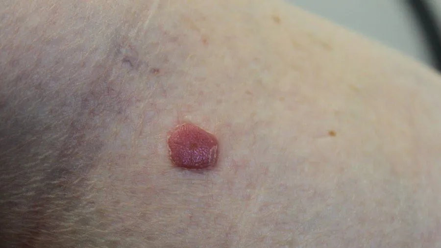 Clinical Feature of Clear Cell Acanthoma