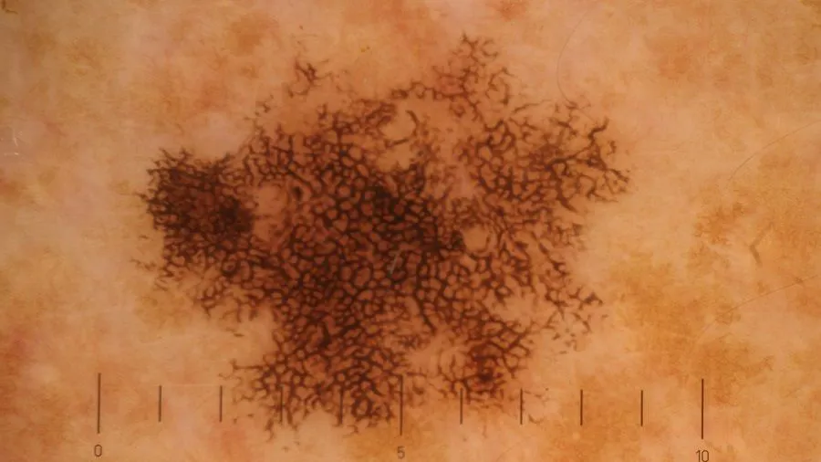 Dermoscopy of Ink Spot Lentigo