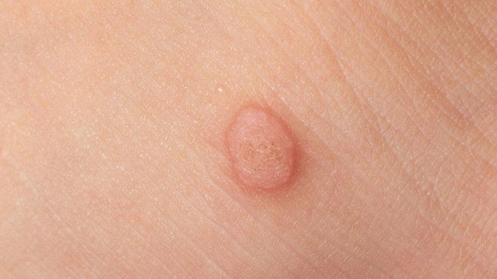 Flat Wart
