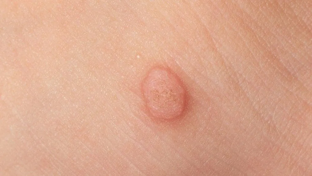 Flat Wart