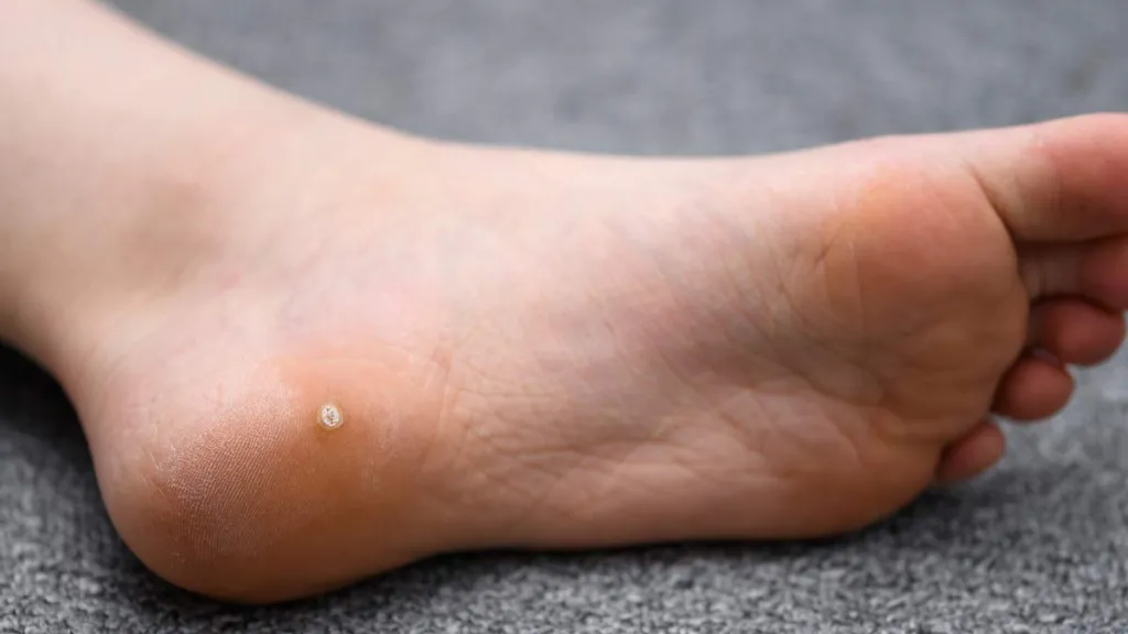Plantar Wart