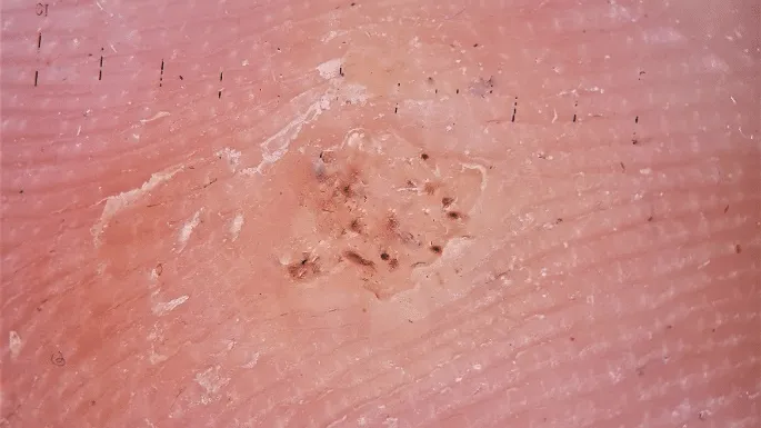 Dermoscopy of Wart