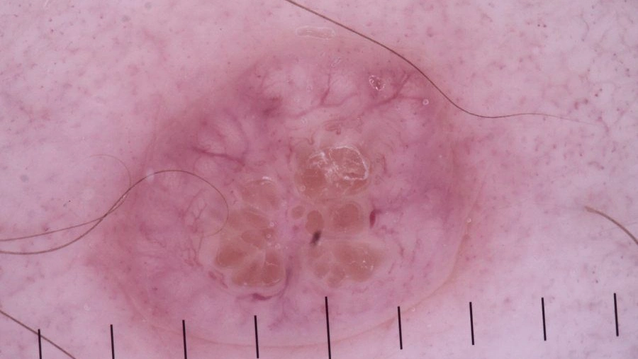 Dermoscopy of Molluscum
