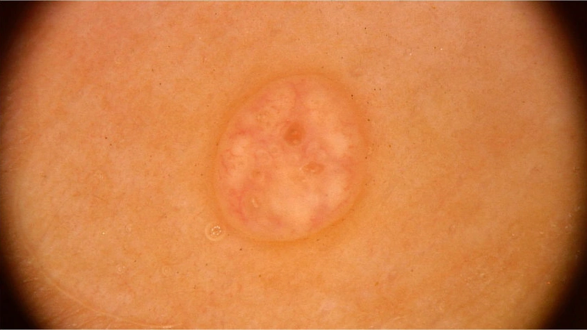 Dermoscopic Features of Molluscum