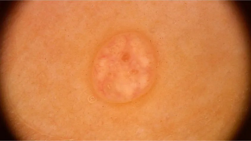 Dermoscopic Features of Molluscum