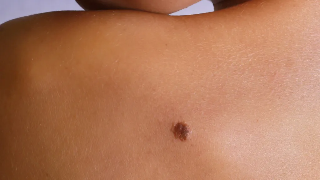 Seborrheic Keratosis