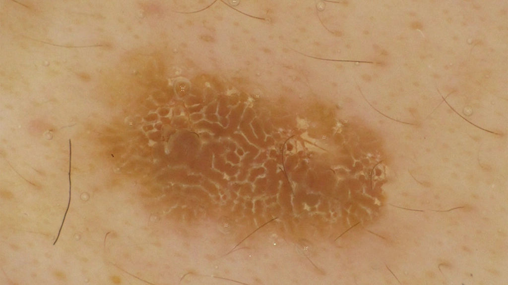 Dermoscopic Features of Seborrheic Keratoses