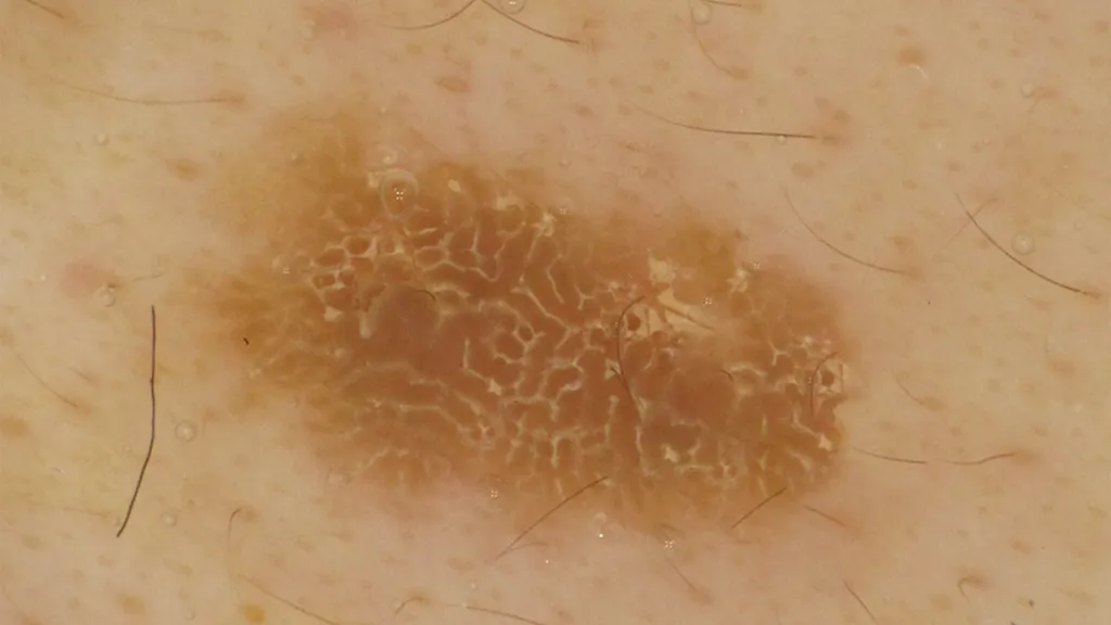 Dermoscopic Features of Seborrheic Keratoses